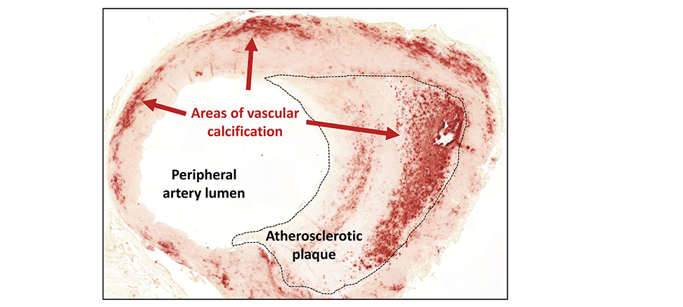 The vascular calcification process